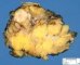 Infiltrating ductular mammary carcinoma