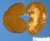 Kidney in cholestatic jaundice