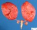 Bilateral non-obstructive renal dysplasia (BNORD) in Meckel (...)