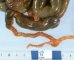 Functional neonatal microcolon by meconial ileus in cystic fibrosis