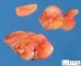 Parotidal embryonal rhabdomyosarcoma