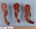 Intestinal intussusception in Peutz-Jeghers syndrome: necrotic (...)