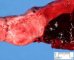 A frequent cause of fetal death: retroplacental hematoma