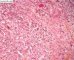 Sclerosing rhabdomyosarcoma
