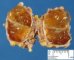 Thyroglossal tract cyst