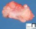Botryoid vesical rhabdomyosarcoma (embryonal rhabdomyosarcoma)