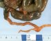 Neonatal meconium ileus with functionnal microcolon in cystic (...)