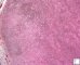 mixed cellularity Hodgkin lymphoma