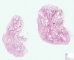 Rectal hyperplastic polyp