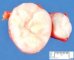 Uterine leiomyoma