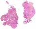 Veinous malformation