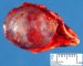Adrenal hematoma