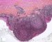 Branchial cyst