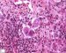Nuclear and cytoplasmic inclusions in CMV fetopathy