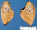 Small hepatoblastoma