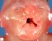 Bilateral lip/palate clefts in Meckel syndrome
