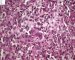 Splenic spumous macrophagic infiltration (Mycobacterium avium infection in (...)