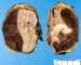 Renal subcapsular hemorrhage complicating a Wilms tumor