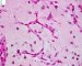 Myxoid liposarcoma