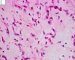 Myxoid liposarcoma