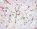 Myxoid liposarcoma (CD34)