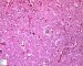 Focal adrenal cytomegaly in 47,XXX fetus ith ring chromosome (...)