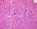 Focal adrenal cytomegaly in 47,XXX fetus ith ring chromosome (...)