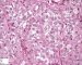 Rhabdoid cells in malignant rhabdoid cells