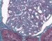 Glomerular mesangiolipidosis in Alagille syndrome