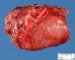 Abdominal cystic lymphangioma