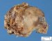 Abdominal cystic lymphangioma