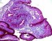 Intestinal metaplasia in stomach (ABPAS)