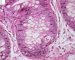 Adenoviral colonic infections