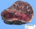 Adrenal neuroblastoma