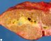Dilatation of large bile ducts in extrahepatic biliary tract (...)