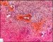 Central giant cell granuloma