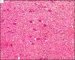 Central giant cell granuloma