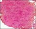 Central giant cell granuloma