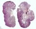 Colorectal tubulous adenoma
