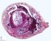 Ectopic tubal pregnancy