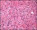 Epithelioid sarcoma