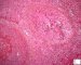 Fungal cutaneous vasculitis in pulmonary invasive aspergillosis