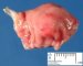 Pancreatic heterotopia in the gastric wall