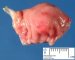 Pancreatic heterotopia in the gastric wall