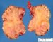 Intestinal loop aggregate in gastroschisis