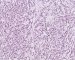 mucinous tubular and spindle cell carcinoma