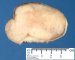 Mammary fibroadenoma