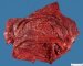 Mesenteric cystic lymphangioma