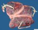 Triple pregnancy placenta