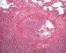 Invasive pulmonary aspergillosis